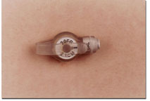 gastrostomy button